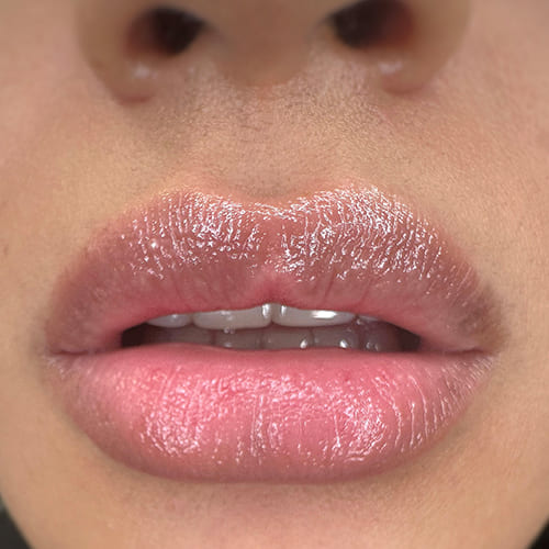 ktr-brows-tratamiento-hydra-lips-madrid-05